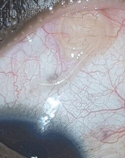 Το NEOflorax βοήθησε να απαλλαγούμε από ένα σκουλήκι στο μάτι